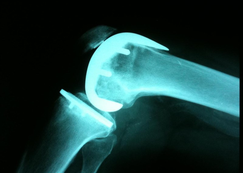 radiografía de rodilla